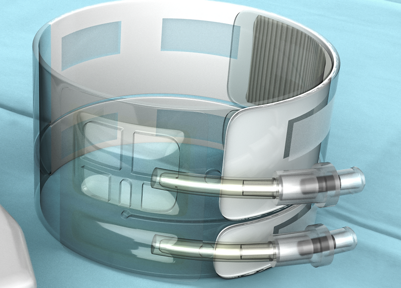 Medical Ingenuities™ transformational PH Band Radial Closure System.